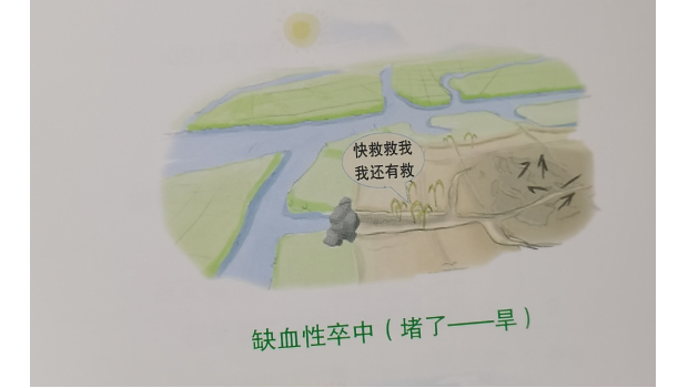 脑卒中如何治疗？