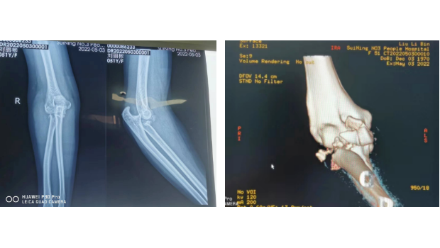 我院成功实施首例人工桡骨头置换术
