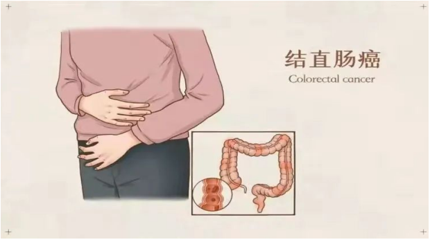 结直肠癌，不再谈癌色变