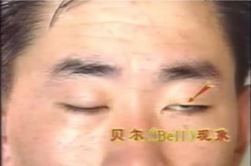 面神经炎患者的护理